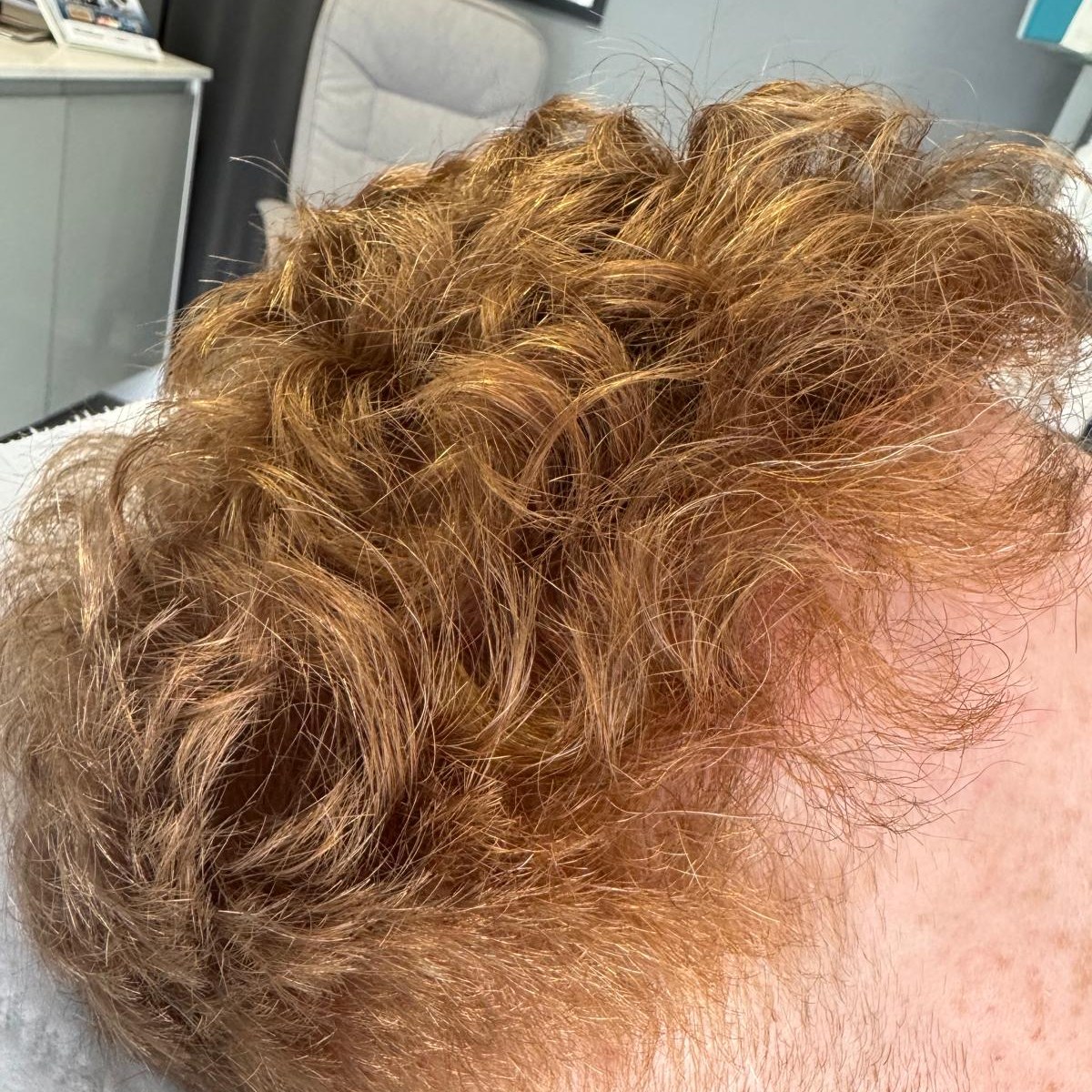 PRP hair treatment